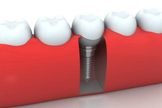 Root canal treatment in Mumbai